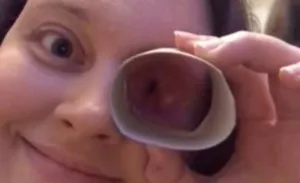 cirurgia-para-cancer-na-cavidade-ocular-faz-mulher-desenvolver-habilidade-inusitada