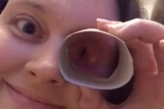 cirurgia-para-cancer-na-cavidade-ocular-faz-mulher-desenvolver-habilidade-inusitada