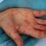 Vacina contra sarampo recomendada em São Paulo