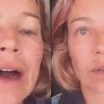Luana Piovani com rosto descamando após laser facial
