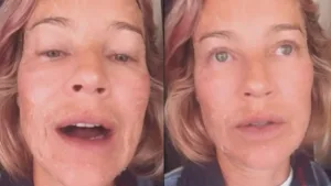 Luana Piovani com rosto descamando após laser facial