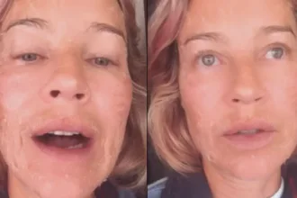 Luana Piovani com rosto descamando após laser facial
