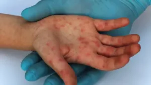 Casos de sarampo em São Paulo aumentam para 28