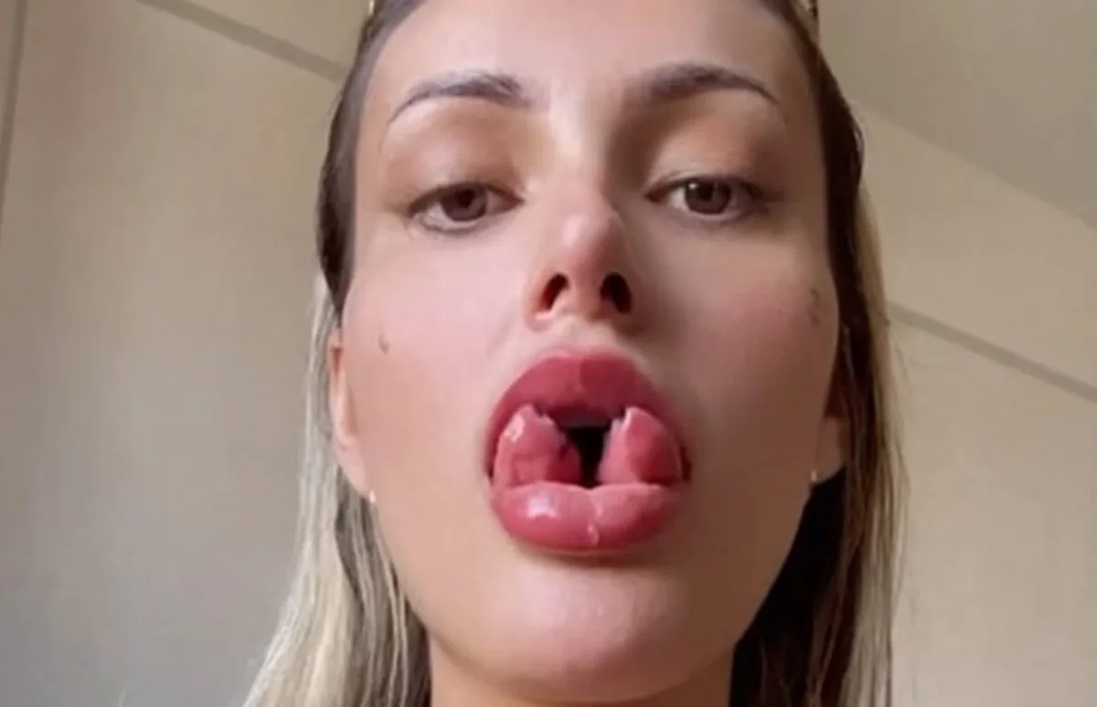 andressa-urach-diz-que-vai-reverter-bifurcacao-na-lingua-apos-acidente-em-gravacao
