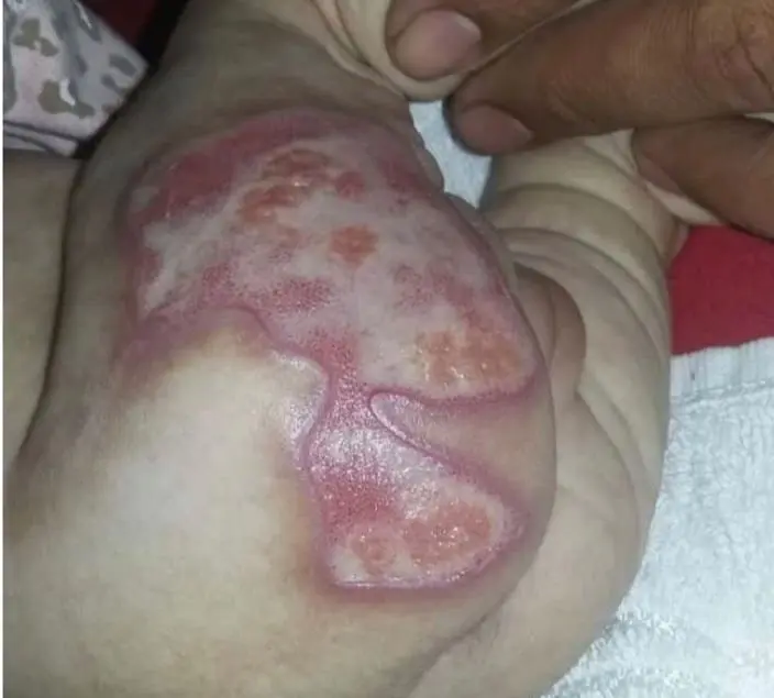 bebe-que-sofreu-queimaduras-em-hospital-de-anapolis-espera-justica-ha-oito-anos:-veja-por-que-o-processo-nao-anda