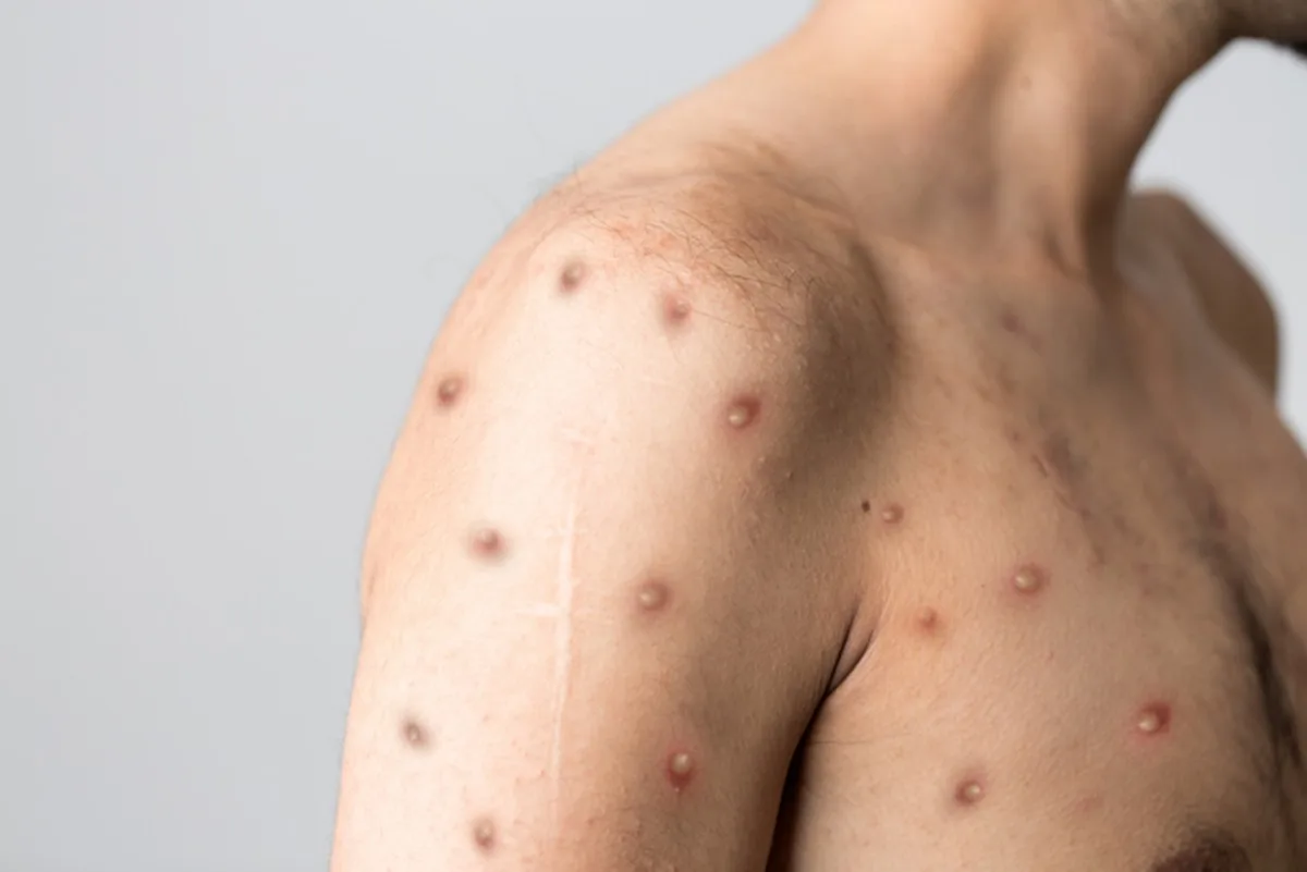 rio-de-janeiro-registra-74-casos-de-mpox-em-dois-meses